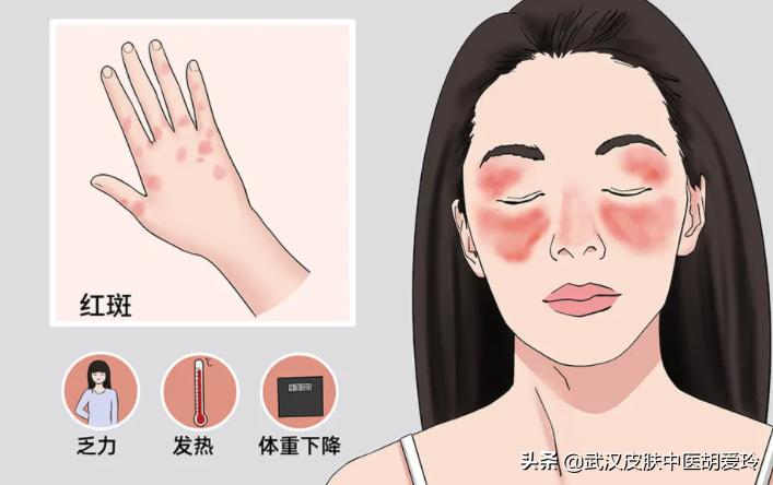 手上无缘无故出现红色斑块,手上无缘无故出现红色条纹