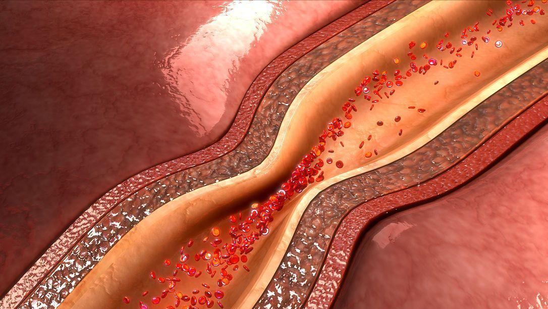 血管狭窄70%放支架还是搭桥好,心血管狭窄搭桥好还是支架好