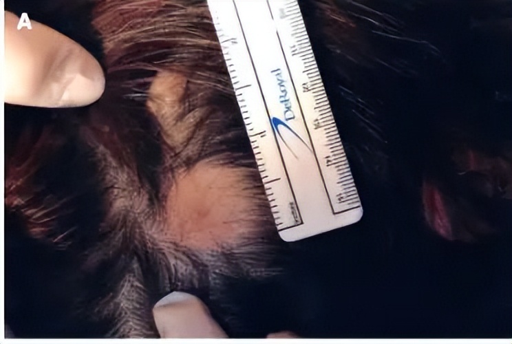 秃头康复,秃头可通过头疗生发吗