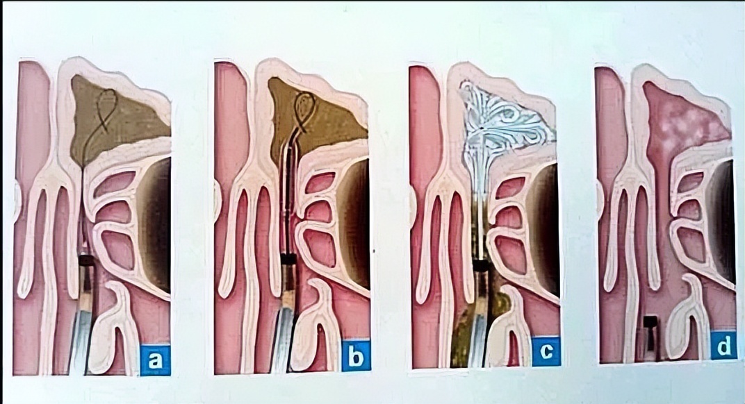 头疼鼻塞脓鼻涕是怎么回事,流鼻涕鼻塞头疼吃什么药好使