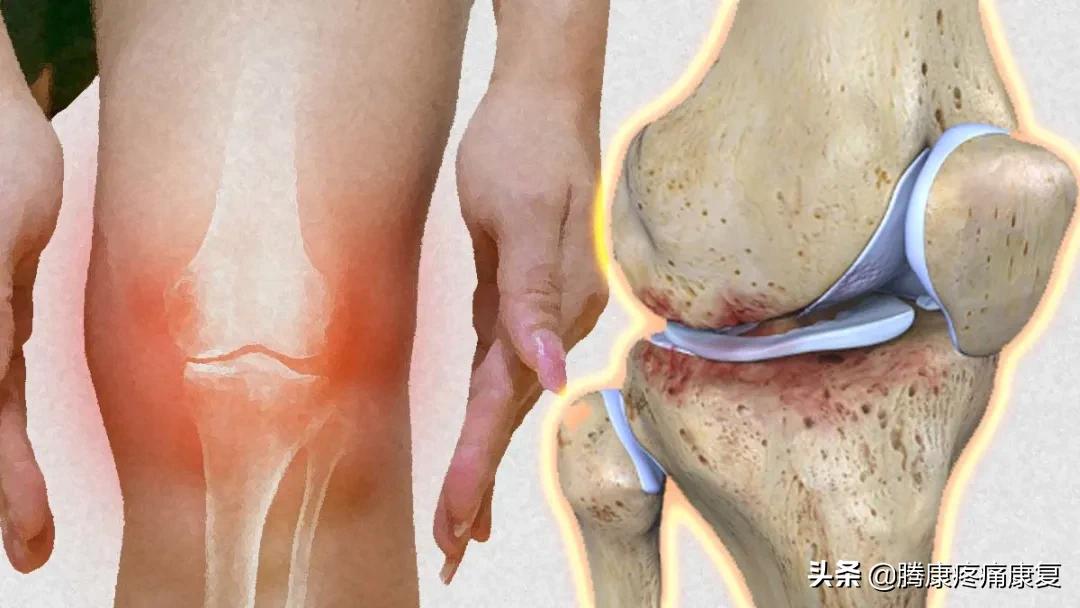 膝关节咔咔响怎么锻炼,膝关节弹响锻炼