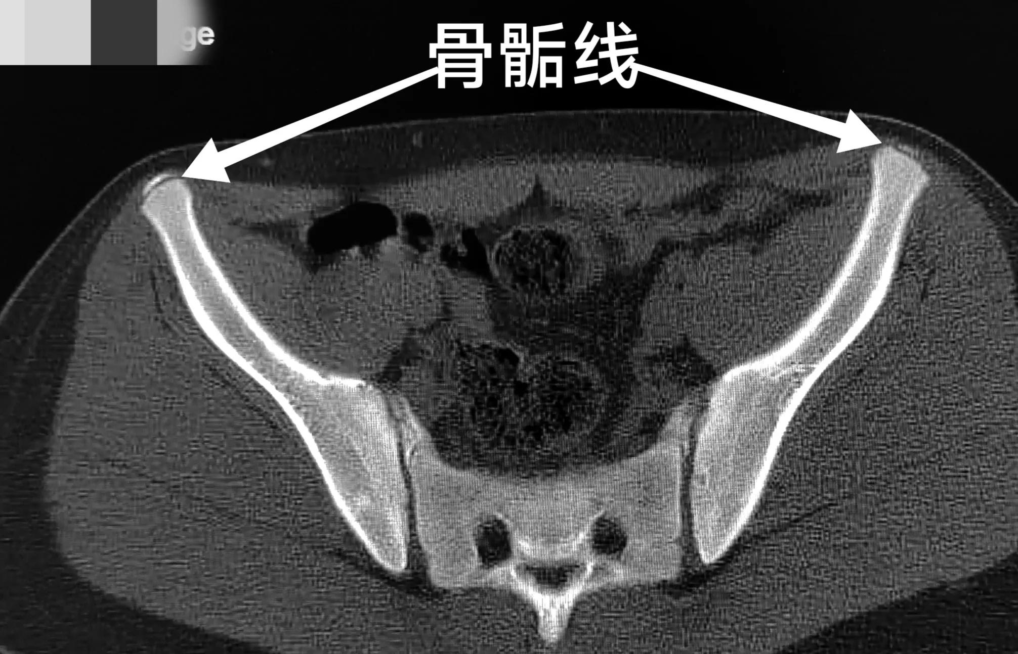 跑完步后大腿根骨头关节疼,跑完步走路大腿根部筋疼痛