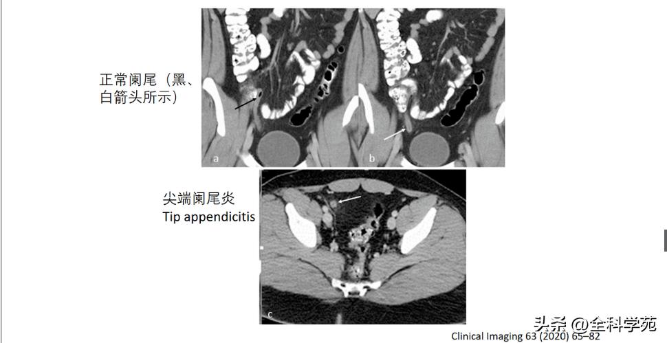 阑尾炎的讲解,关于阑尾炎的讨论总结