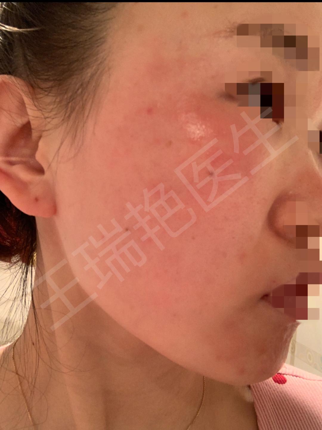 烂脸警告完整视频,烂脸警告