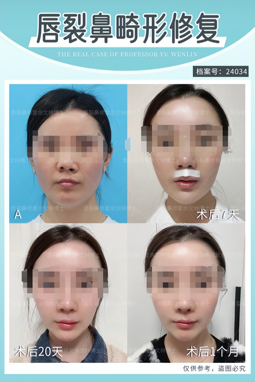 兔唇可以修复吗,兔唇修复能和正常人一样吗