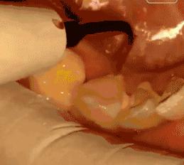 牙齿矫正期间如何让牙齿不变黄,牙齿做完矫正之后变黄了怎么办