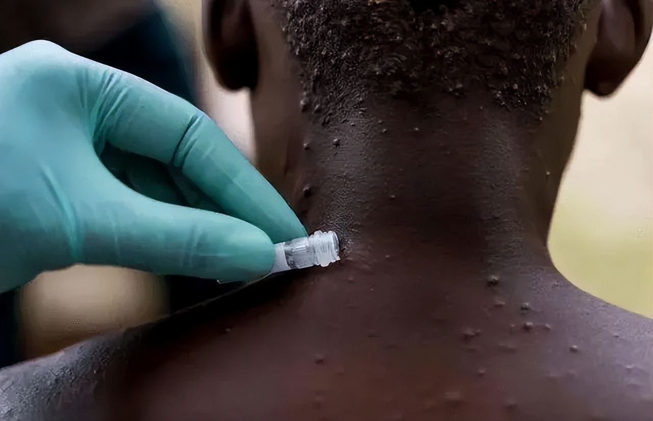 天花病毒会不会再爆发,天花病毒从发现到灭亡