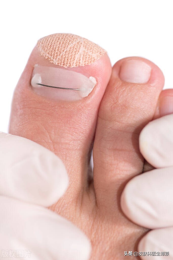 皮肤科医生一招教你去除灰指甲,治疗灰指甲最好最有效的根治办法
