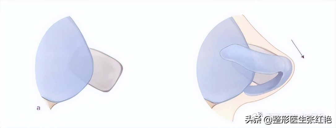 塌鼻头大鼻头怎么修容,塌鼻子和大鼻头如何变高挺