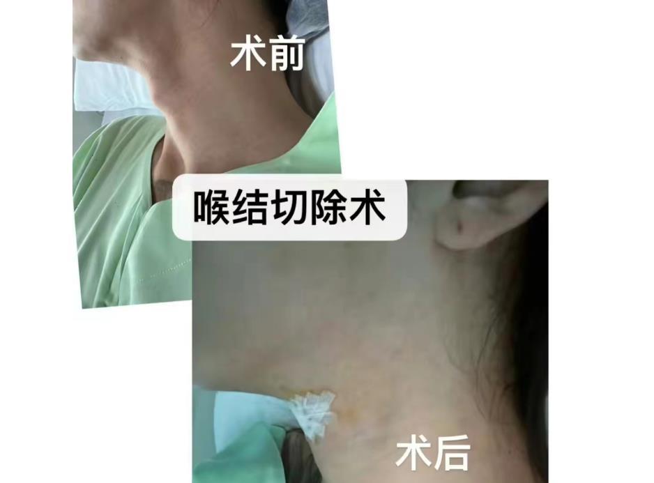 去泰国做变性手术的网红是谁,28岁网红去泰国做变性