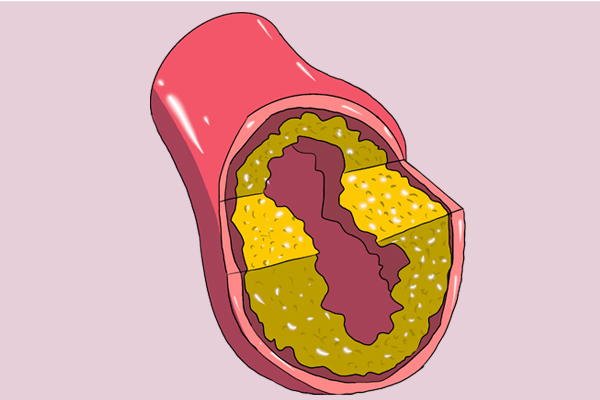 氯沙坦和阿利沙坦哪个效果好,进口沙坦药和国产有什么区别