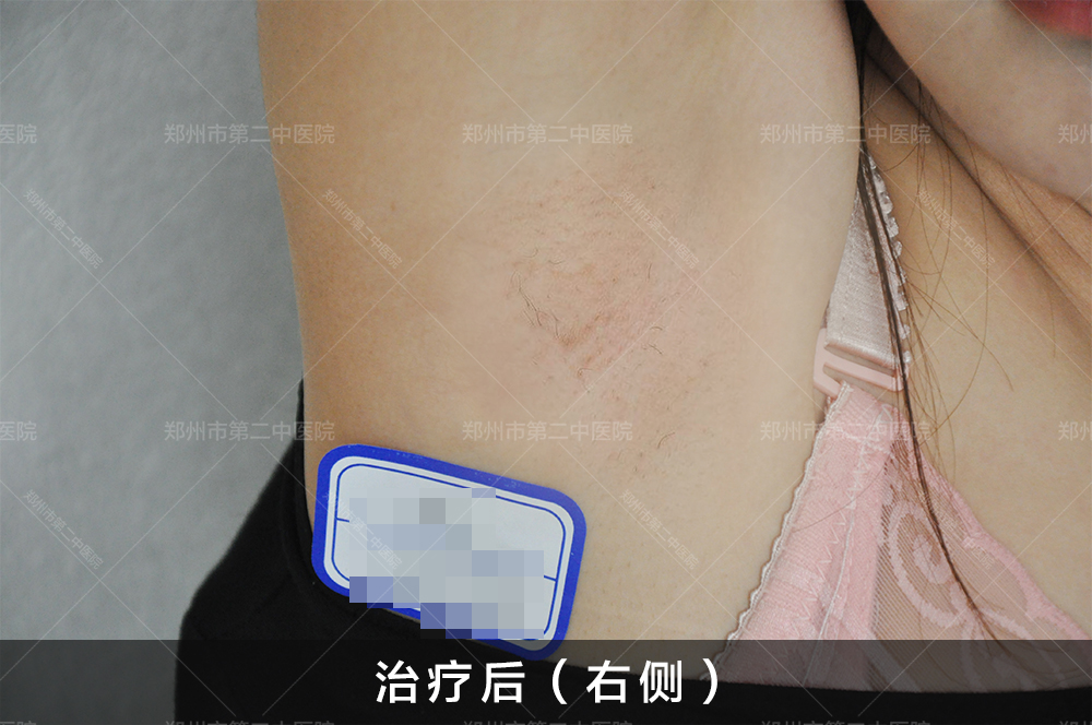 郑州腋下祛疤痕,郑州市第二中医院祛疤靠谱吗