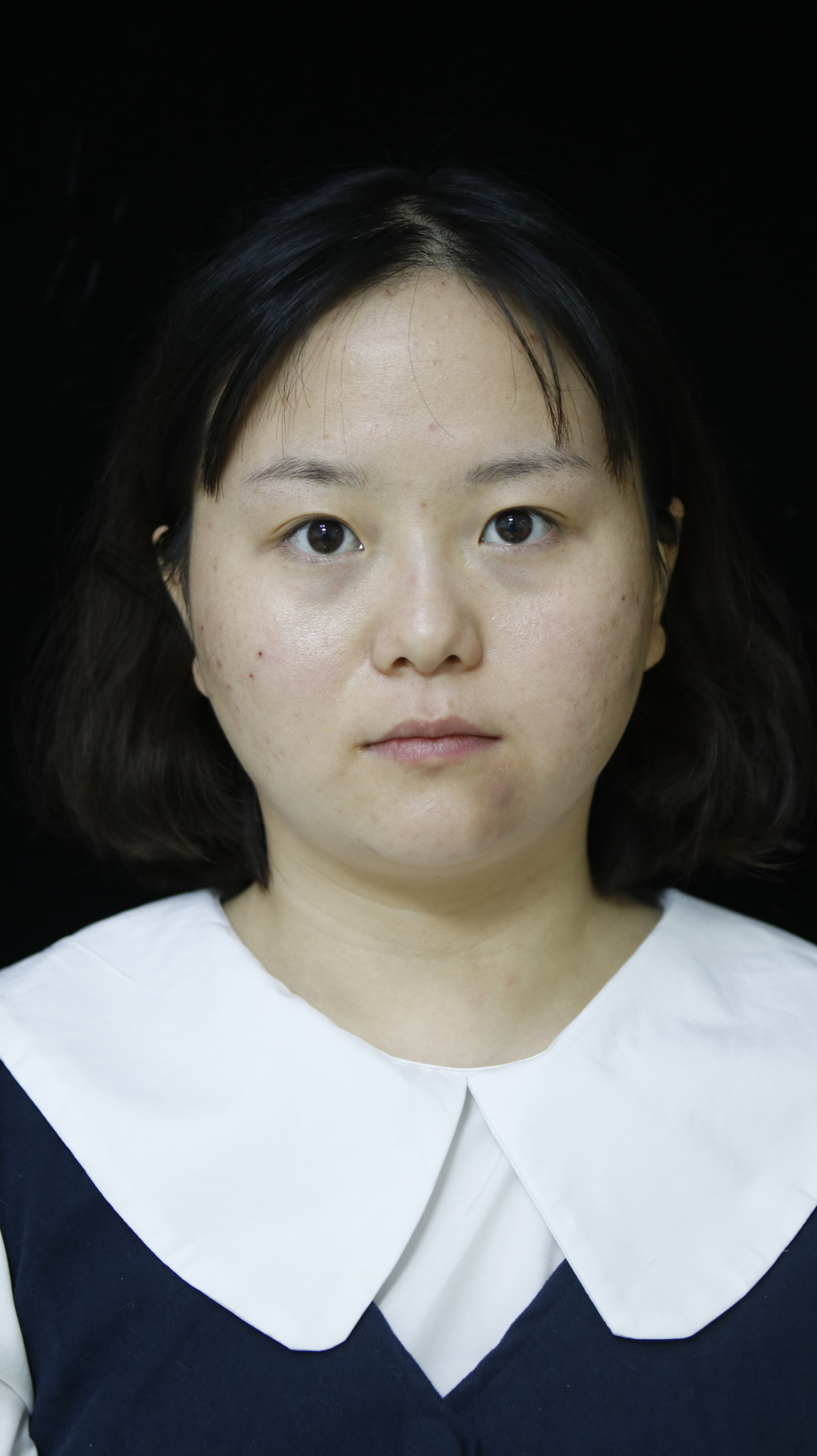 10年后去不掉的眼袋,年轻时的眼袋是怎么样的