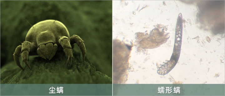 被螨虫叮咬产生刺痒怎样才能止痒,刺痒疙瘩怎么治疗