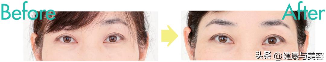 去鱼尾纹法令纹最好的方法,如何提拉眼尾去鱼尾纹