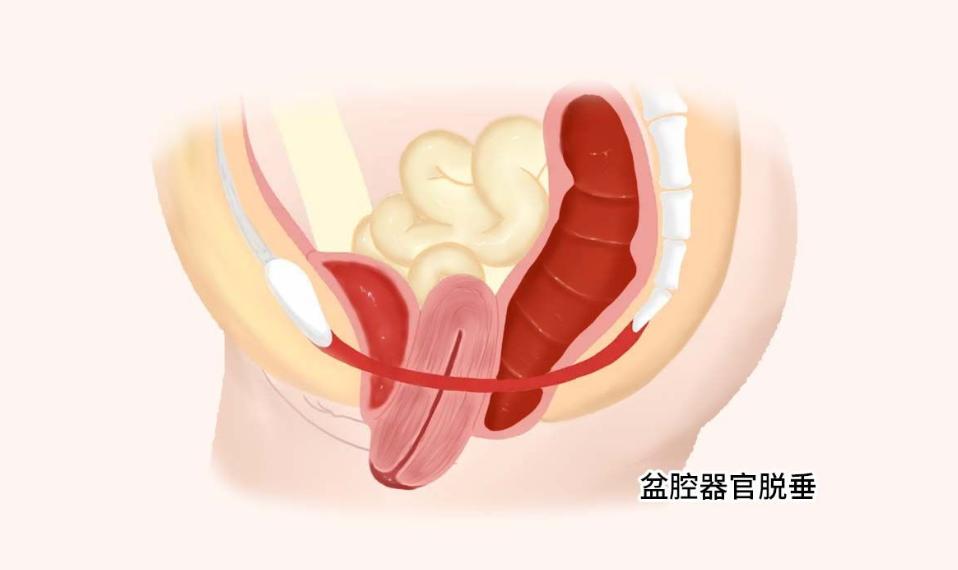 子宫癌早期的三种症状,子宫癌早期10种症状