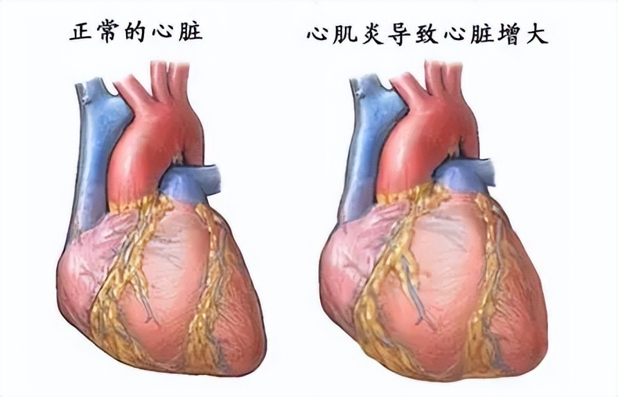 中医治疗病毒性心肌炎穴位,治疗心肌炎的中草药主治