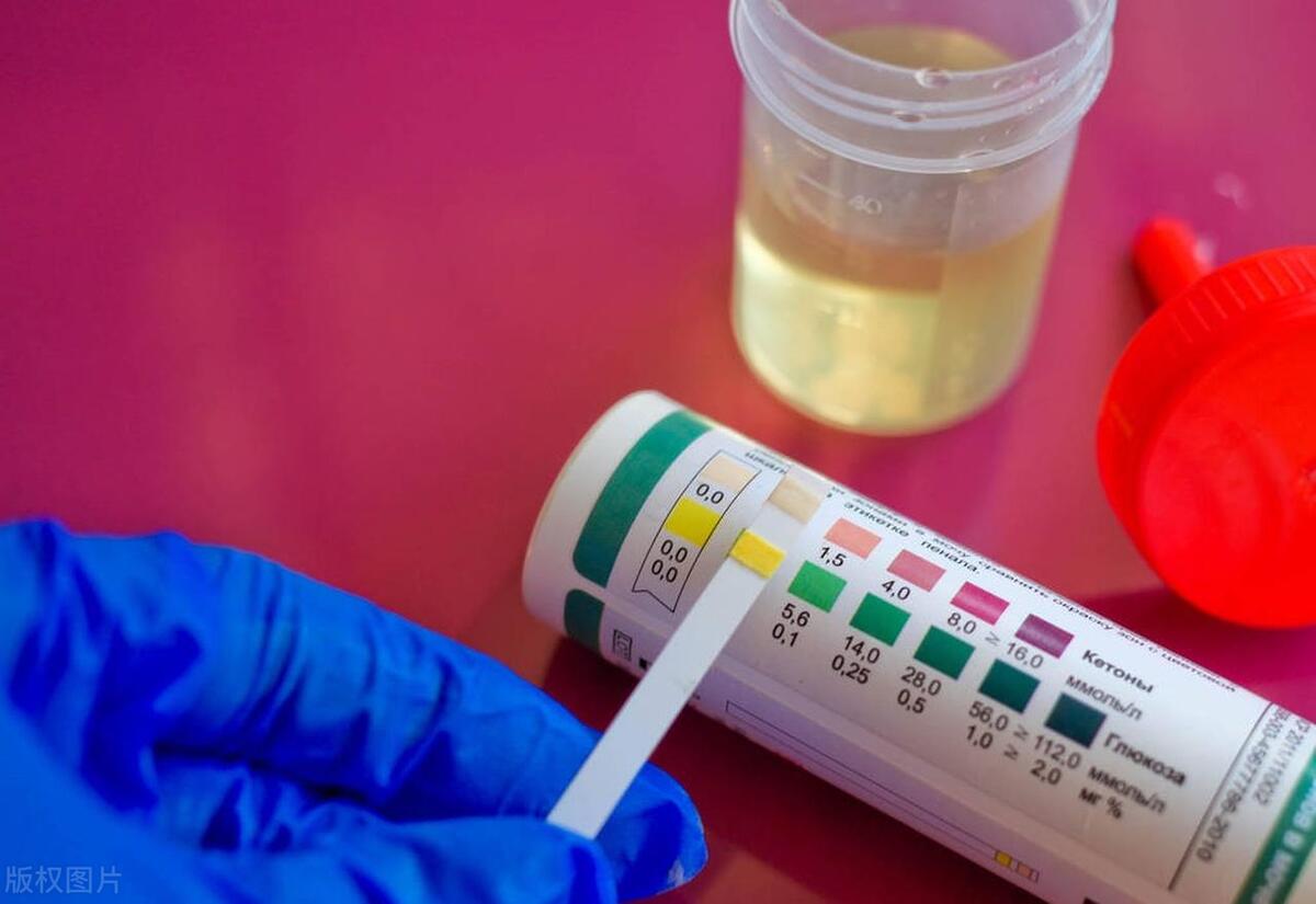 尿常规中有星号是什么意思,尿常规上-号代表什么