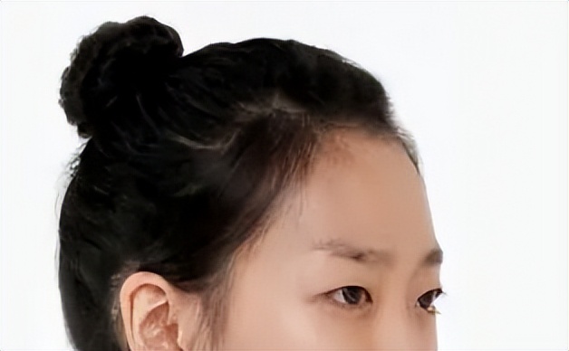 打玻尿酸变美的案例,额头玻尿酸1-7天恢复过程图