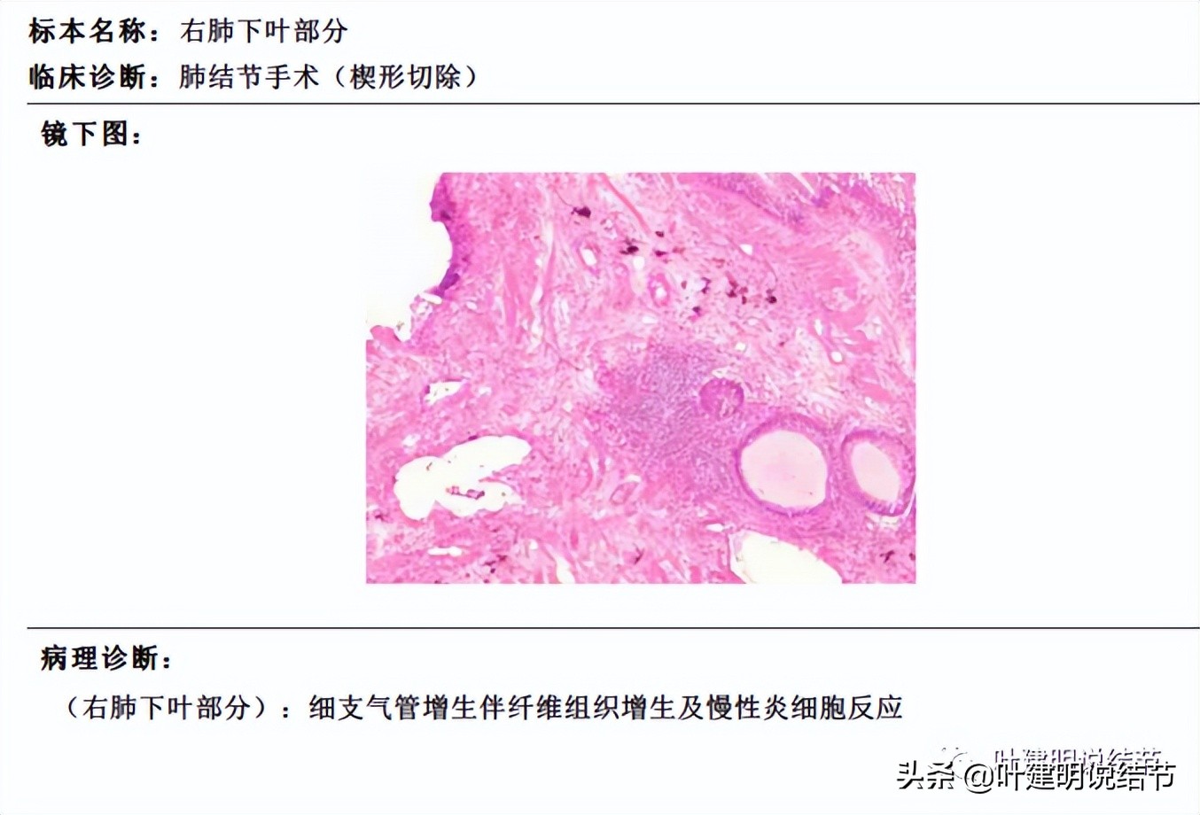 误诊肺纤维化,肺蜂窝状是癌吗