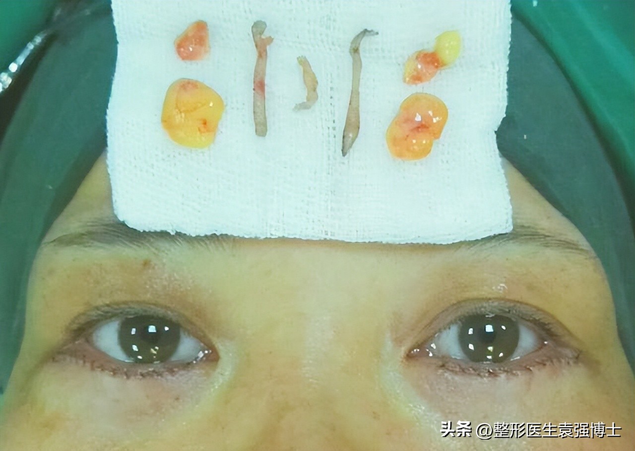 如何解决眼周衰老症状,眼周肌肤出现衰老怎么办