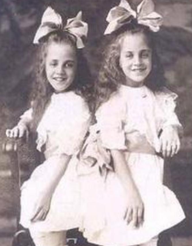 英国连体双胞胎姐妹,英国连体姐妹