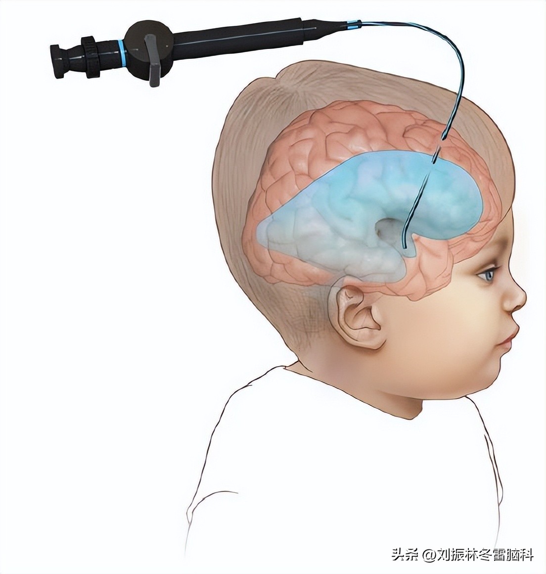 头痛恶心呕吐后缓解,小儿头痛呕吐是怎么回事