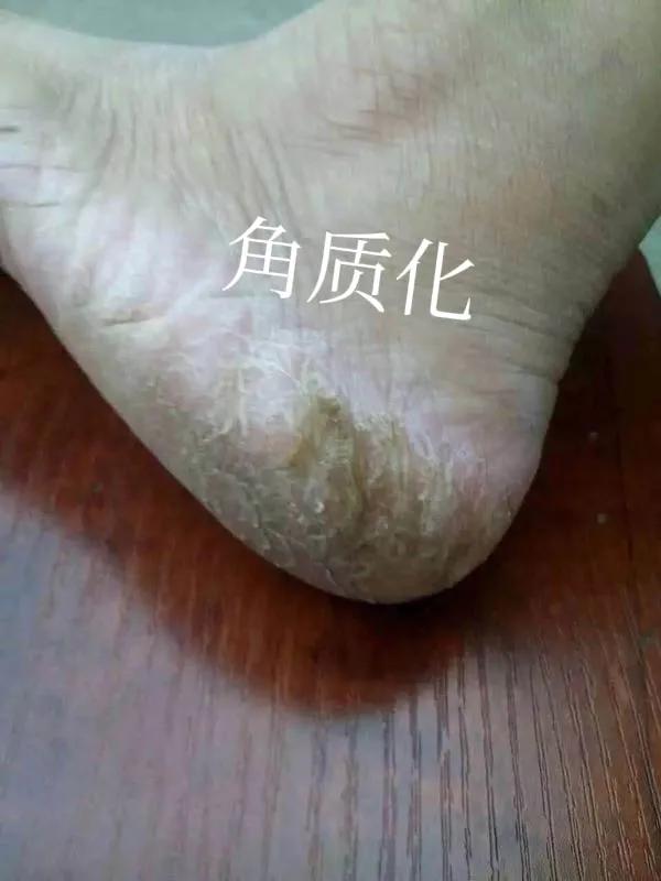 用过足光散后一直脱皮不好,用了足光散脱皮正常吗