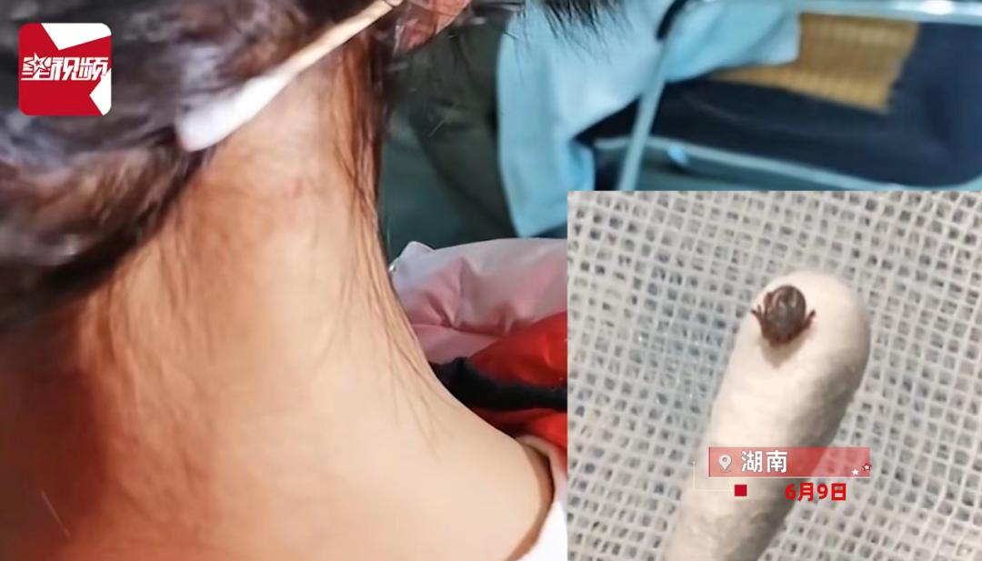 夏季常见蚊虫叮咬图鉴,女孩被家人吸血10年