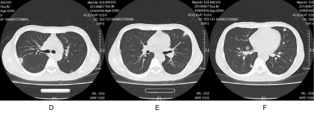 mrsa用什么药,mrsa对哪些药物敏感