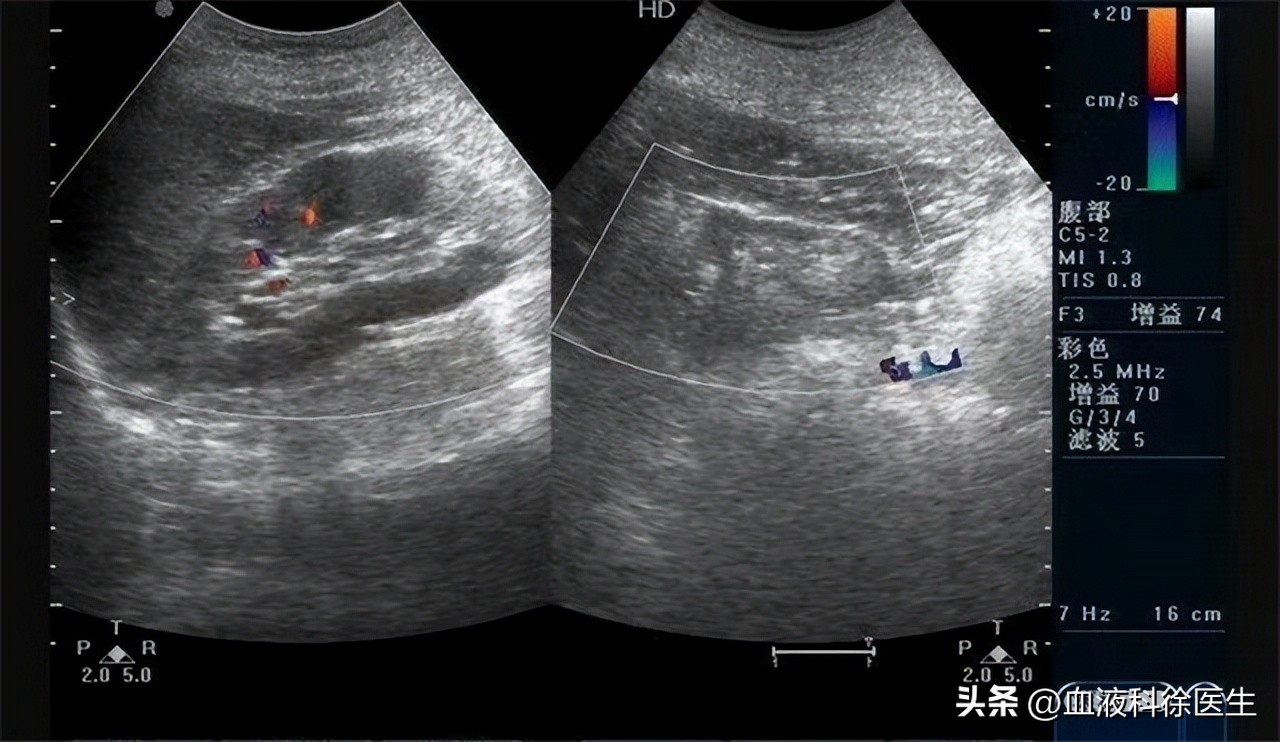 肾衰竭有这5个征兆不痛不痒,肾衰竭为什么就不排水了