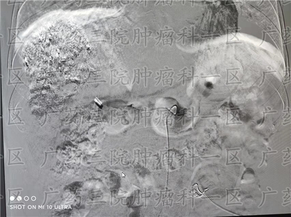 下肢水肿竟是肝癌引起?广药三院肿瘤科一区彭齐荣