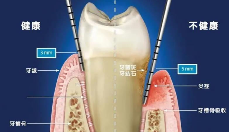 北大口腔龈下刮治,口腔诊所龈下刮治靠谱吗