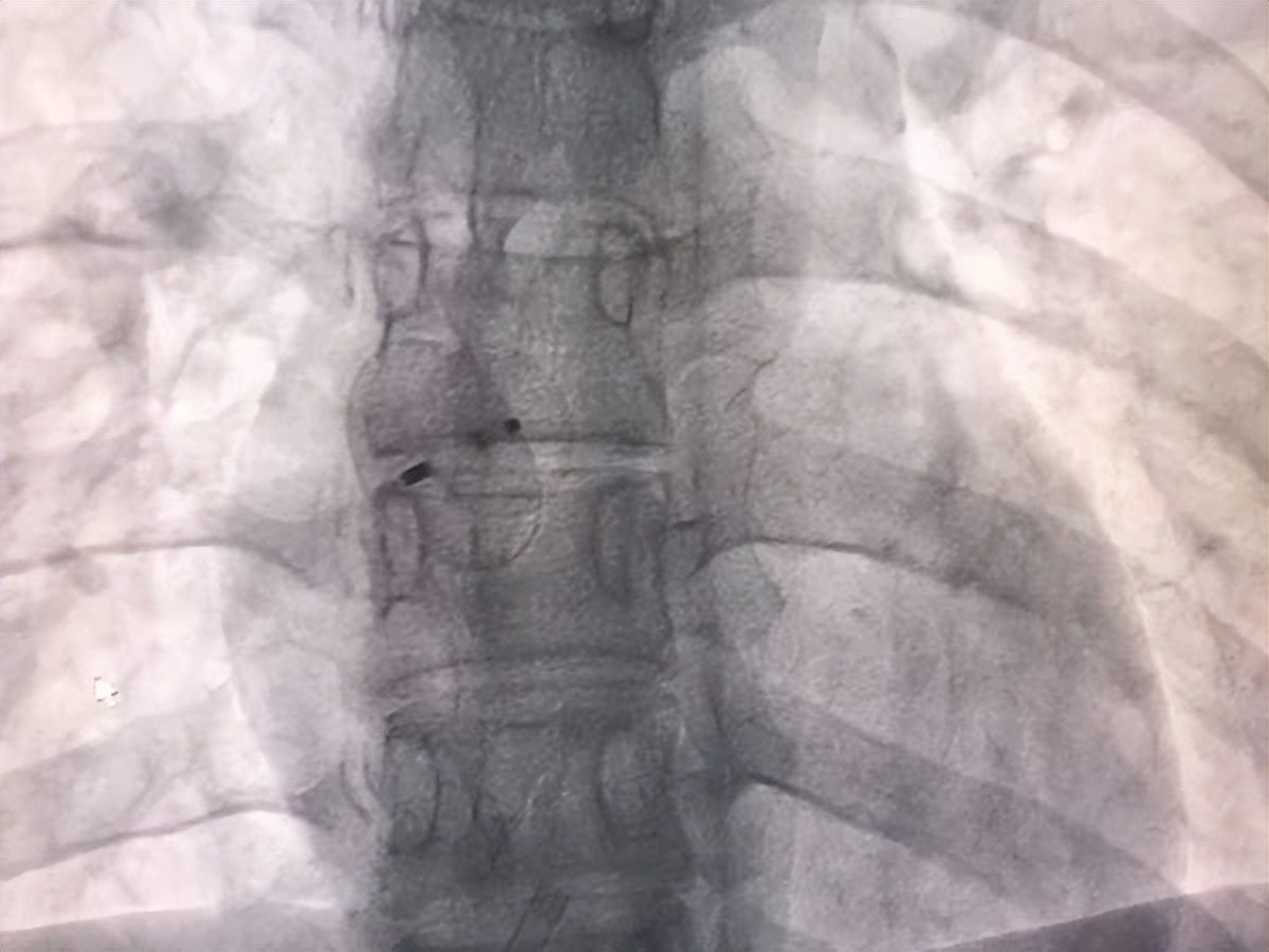 汝州市人民医院：长期头痛诊断是“心”病
