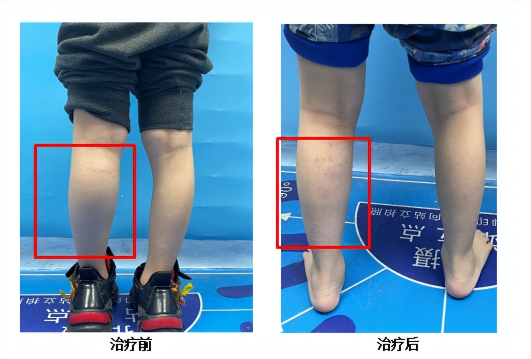 下肢血管畸形介入,小腿血管畸形介入治疗注意什么