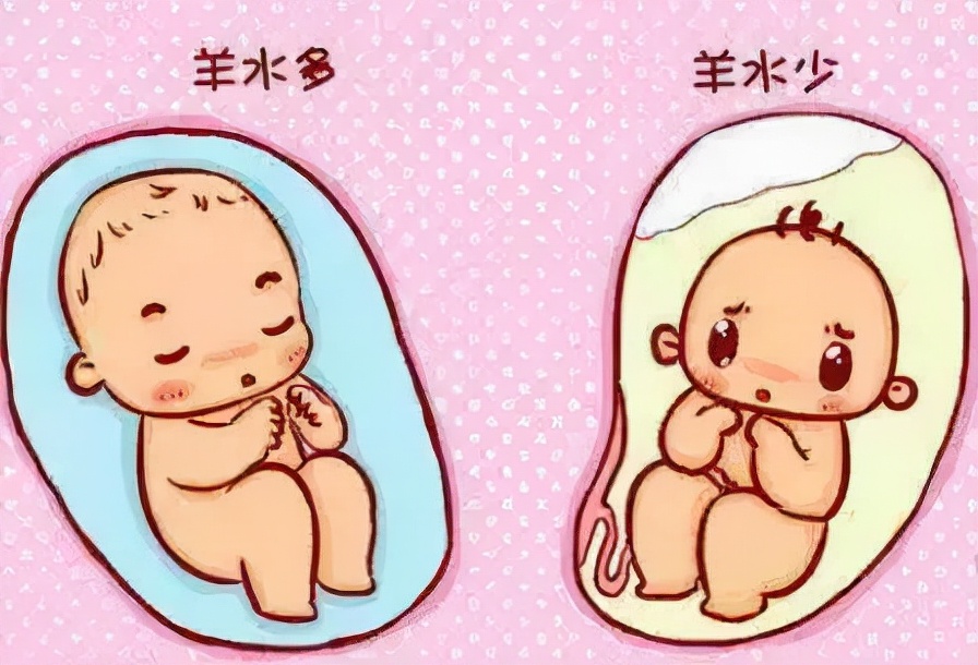 孕期知识什么是羊水栓塞,孕期破水的科普