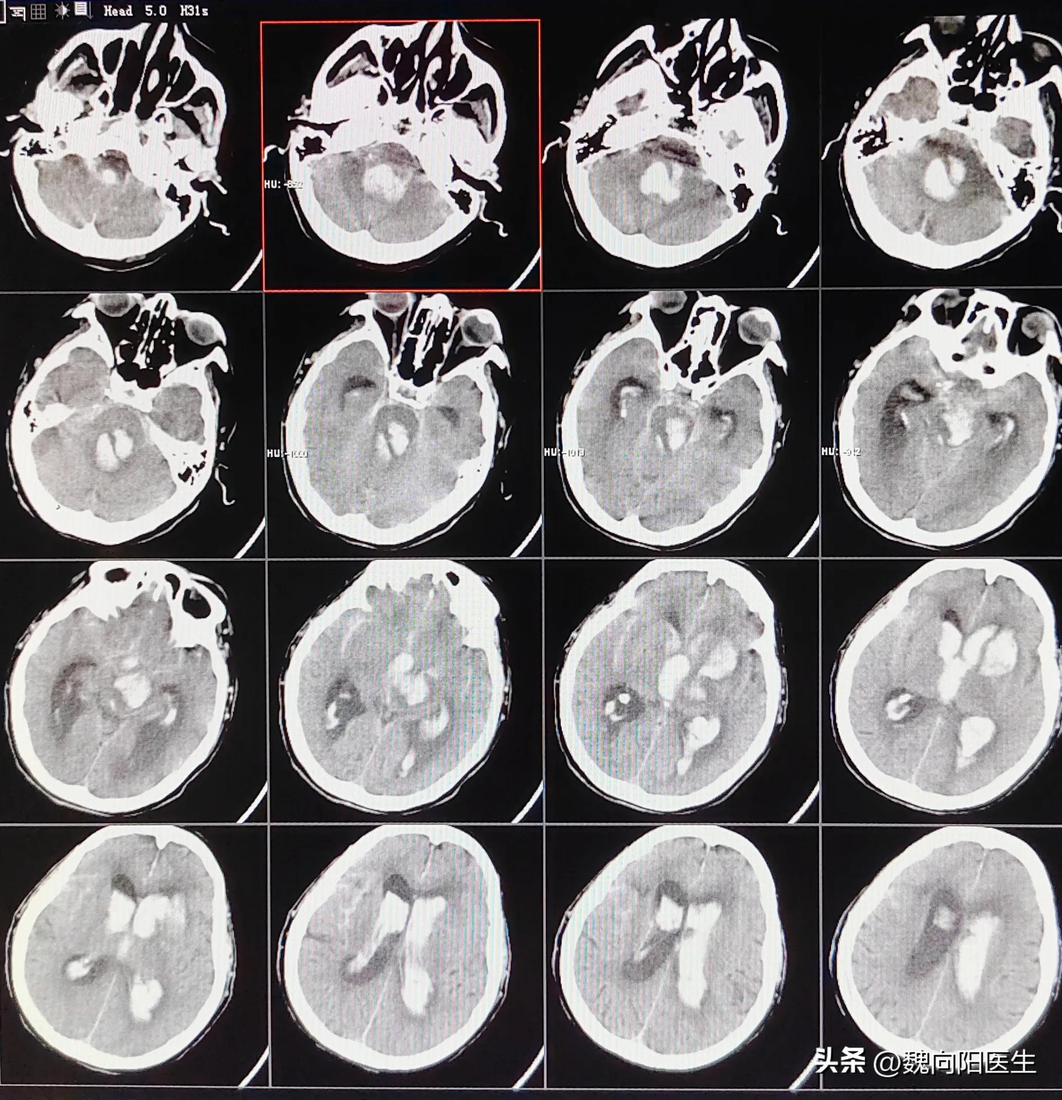 有可能治成“活死人”的脑出血患者，选择治和不治，都是正确的