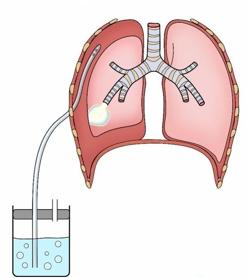 气胸插管排气后呼吸依然很痛,气胸呼吸时咯吱响