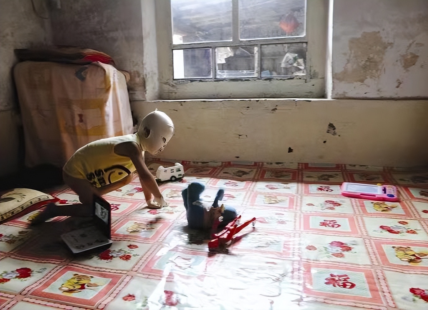 小孩被火烧伤戴面具,面具娃娃烧伤