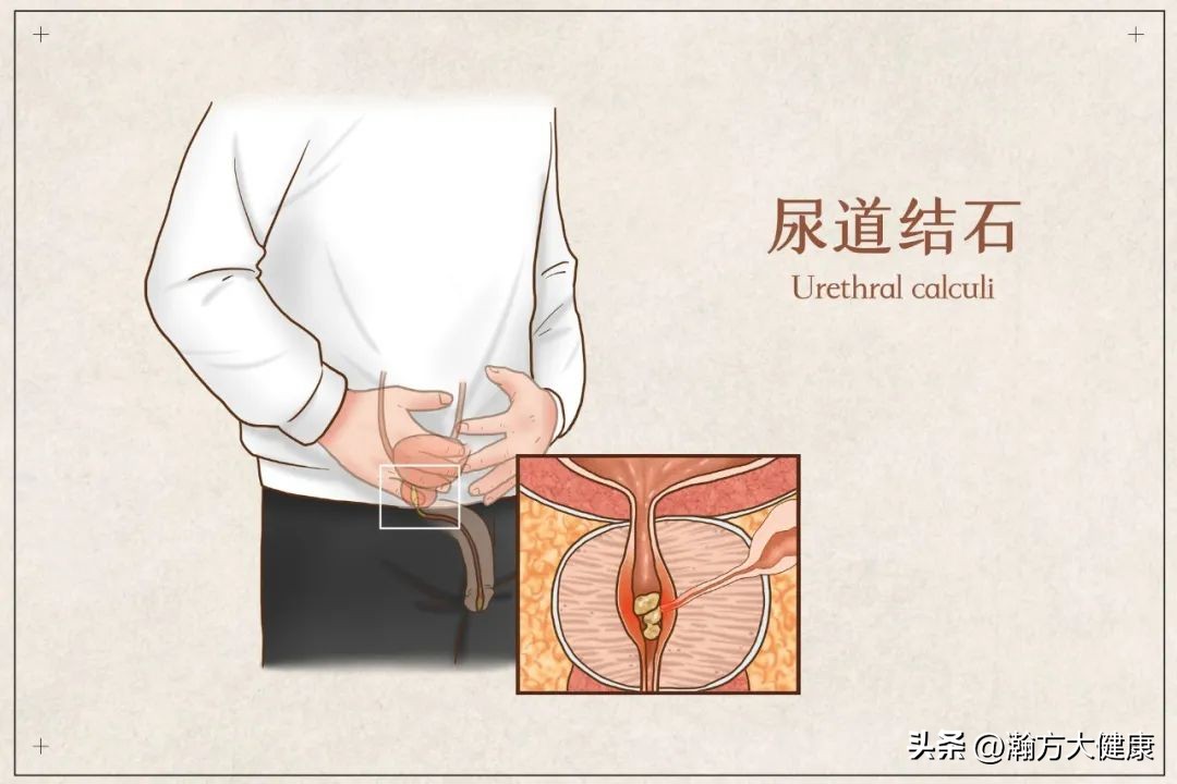 尿路感染容易引起感冒吗,患上了尿路感染怎么办