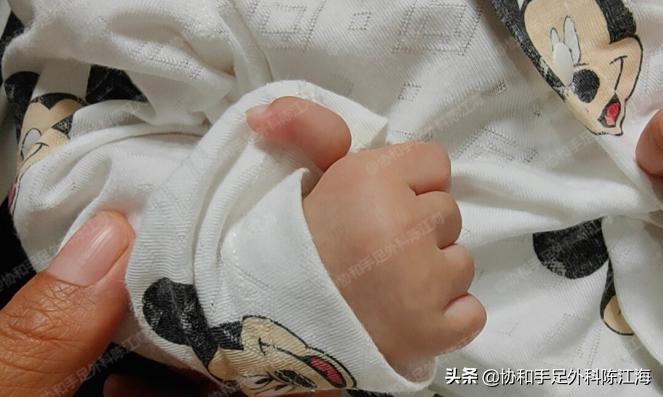 两个月宝宝大拇指连着手掌,三个月婴儿拇指并指可以手术吗