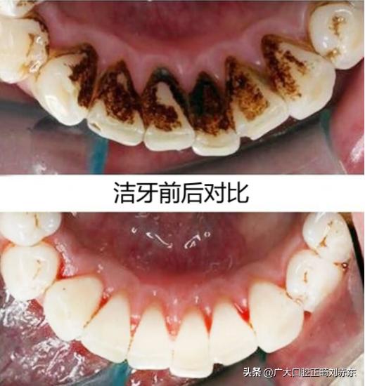 吃槟榔牙齿发黄怎么去除变白,牙齿抽烟发黄怎么去除变白