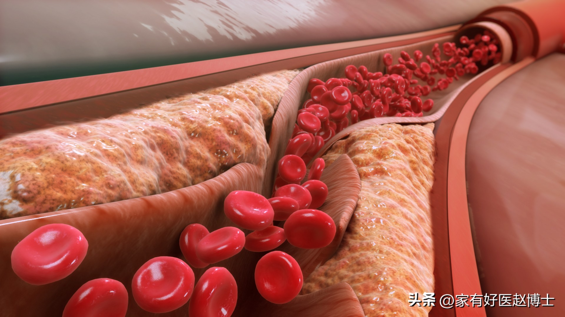 高密度胆固醇hdl偏低应该如何饮食,高密度脂蛋白胆固醇hdl偏低0.85