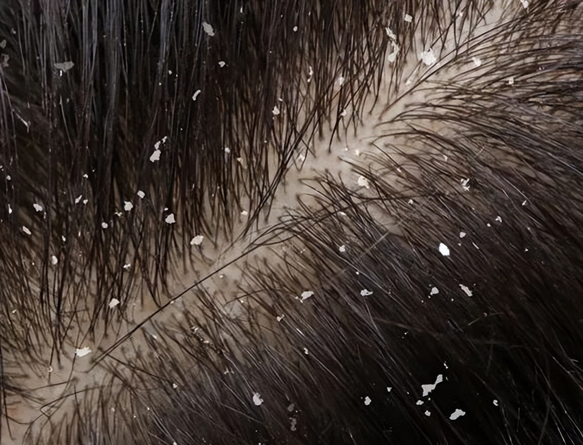 头皮发痒头屑多如何见效快,头皮发痒头屑多有什么好办法