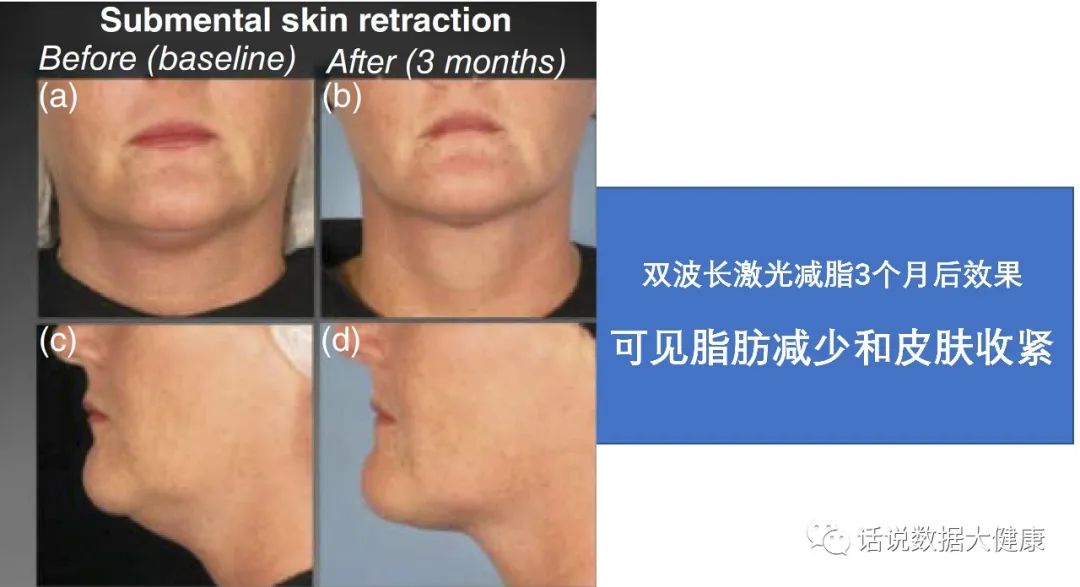 激光减脂，又一个明星医美产品，效果如何？