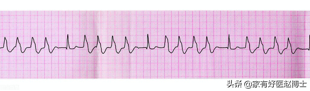 心脏早搏怎么治疗和预防,心脏早搏怎么知道轻微还是严重