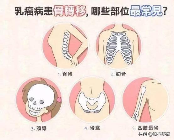 刀口痛、上肢痛...铂桐医疗为您解答造成乳腺癌疼痛的4大原因