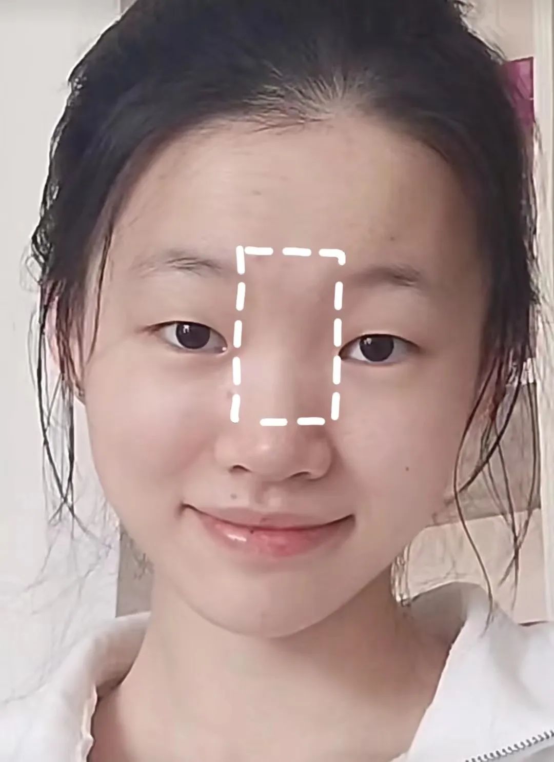 塌鼻子正脸好看,塌鼻子该如何变美啊