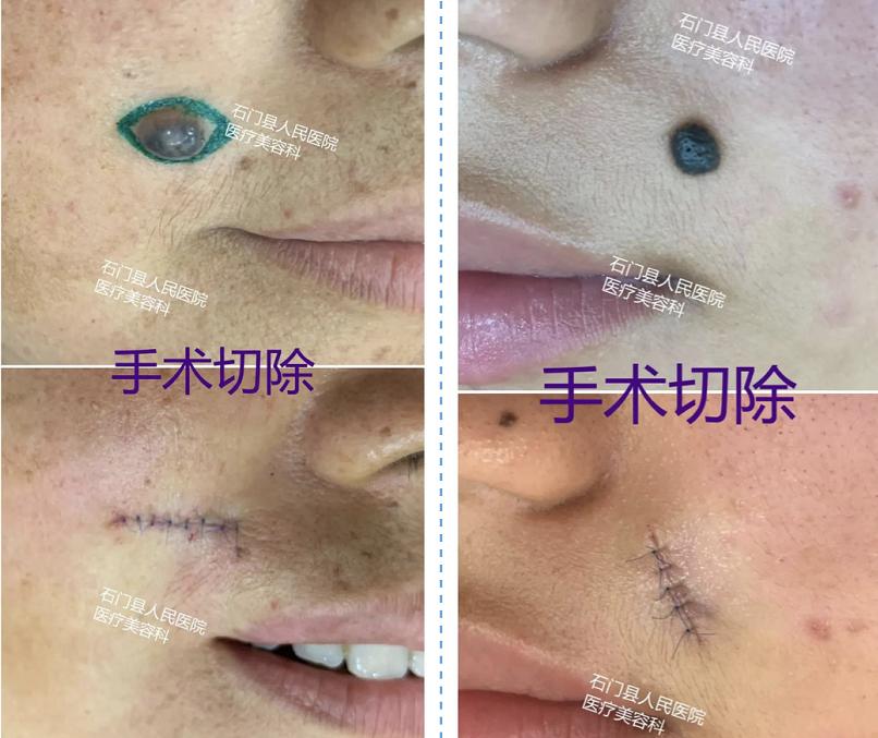 有痣人士点痣要慎重,肉痣怎么点痣最靠谱