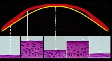 角膜塑形镜控制度数的原理是什么,角膜塑形镜控制近视度数增长